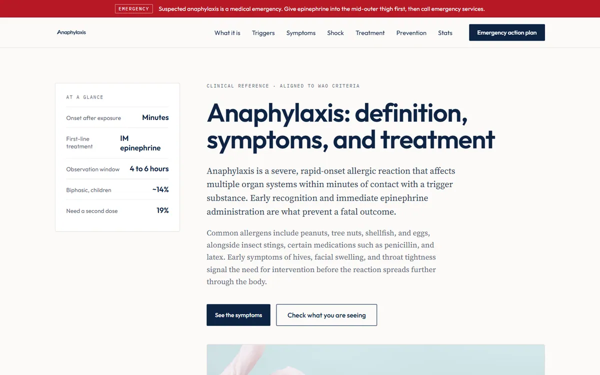 Anaphylaxis Health reference site with the headline 'Anaphylaxis: definition, symptoms, and treatment' and an at-a-glance fact panel